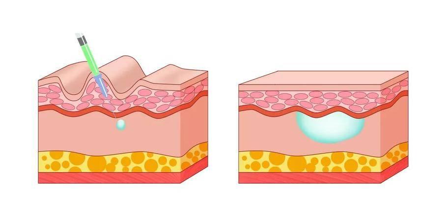 法令紋去除最安全永久的方法，全面解析與實(shí)用建議，全面解析法令紋永久安全去除法，實(shí)用建議與最佳實(shí)踐