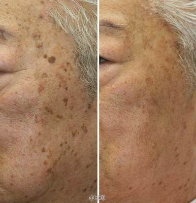 如何有效去除老年斑——全面解析，全面解析，有效去除老年斑的方法