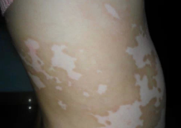 白顛瘋病初期照片癥狀圖片，了解白癜風(fēng)早期表現(xiàn)與防治，白癜風(fēng)初期癥狀圖片解析，了解白癜風(fēng)早期表現(xiàn)與防治攻略