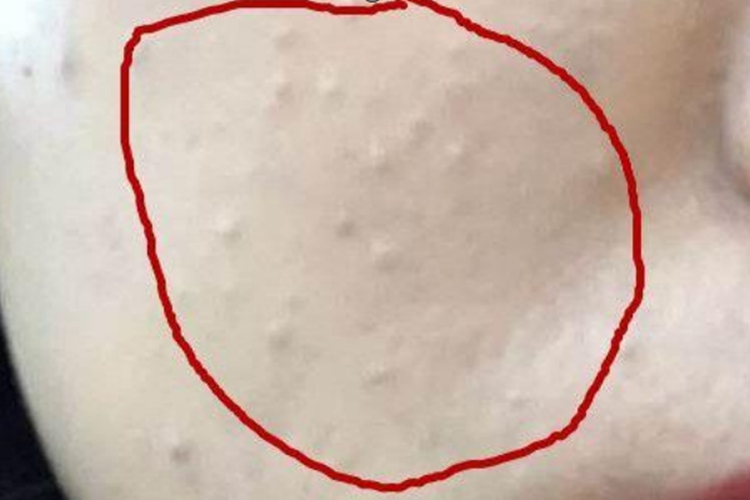 粉刺長(zhǎng)什么樣子？圖片解析帶你深入了解，粉刺詳解，圖片解析帶你探索其真實(shí)面貌