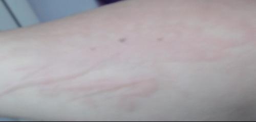 急性過敏性蕁麻疹，全面解析與應對策略，急性過敏性蕁麻疹，全面解析及應對指南