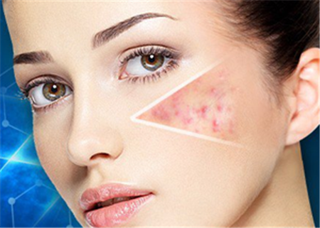 激光祛痘印大概需要多少錢呢？全面解析費(fèi)用因素與注意事項(xiàng)，激光祛痘印費(fèi)用全解析，費(fèi)用因素與注意事項(xiàng)，了解需要多少錢！