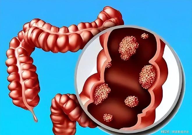 大便形態(tài)變化，細(xì)探腸癌征兆，大便形態(tài)變化揭示腸癌征兆