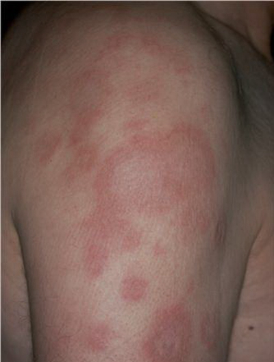 艾滋病紅斑早期圖片，了解、預防與應對，艾滋病紅斑早期圖片詳解，預防與應對策略