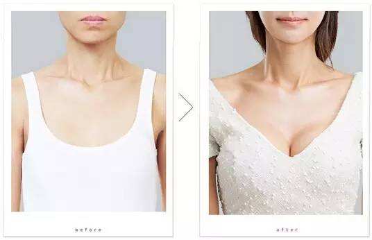 假體隆胸恢復(fù)期是多久，全面解讀隆胸術(shù)后恢復(fù)過程，全面解讀假體隆胸術(shù)后恢復(fù)過程，恢復(fù)期的時長與細(xì)節(jié)解析