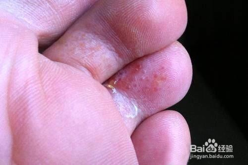 腳氣是怎么引起的，深度解析原因與防治策略，深度解析，腳氣成因及防治策略指南