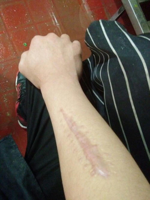 參軍疤痕標(biāo)準(zhǔn)解析，參軍疤痕標(biāo)準(zhǔn)詳解