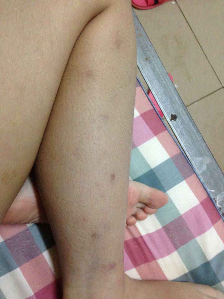 蚊子咬后留下黑疤如何去除——全面解析去除黑疤的有效方法，蚊子咬后黑疤如何去除，有效方法全面解析