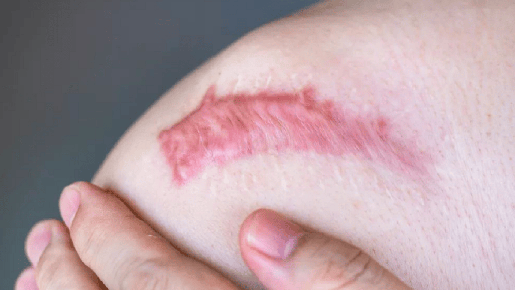 疤痕增生，成因、治療與預(yù)防，疤痕增生，成因、治療方法及預(yù)防措施