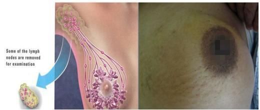 如何排除乳腺癌，自我預防與早期發(fā)現的重要性，如何預防與早期發(fā)現乳腺癌，自我檢查與重要性解析