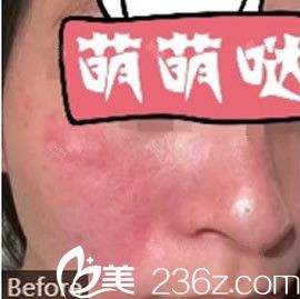 去紅血絲激光手術費用詳解，多少錢？，激光去紅血絲手術費用全面解析，費用究竟是多少？