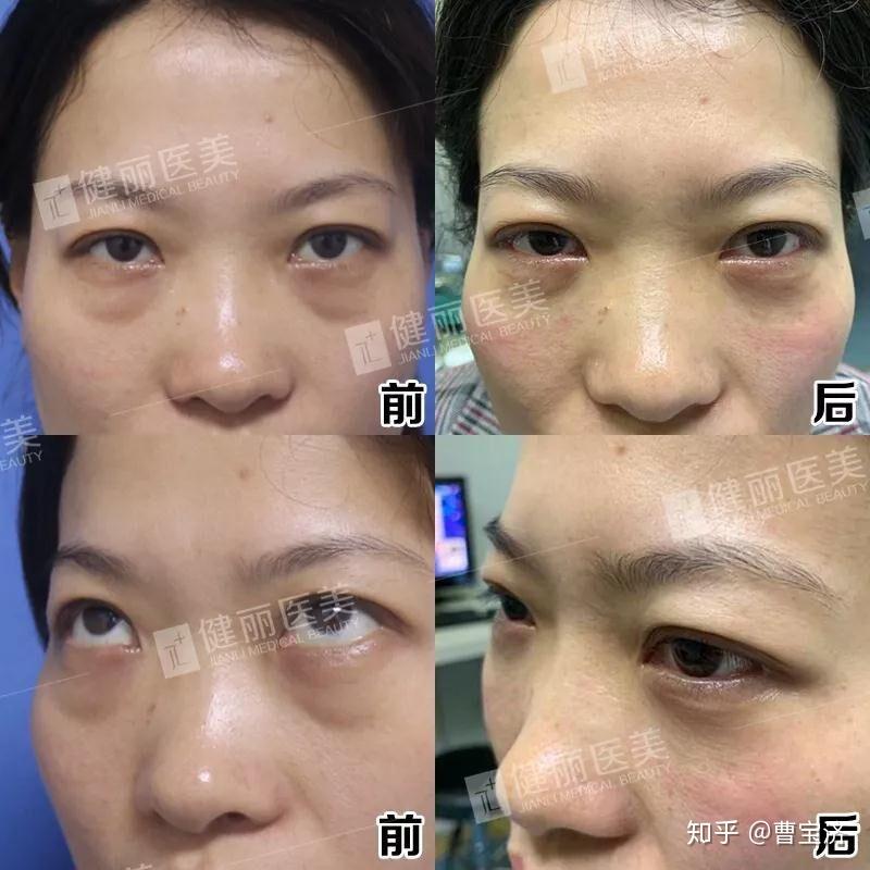 如何有效去除黑眼圈與眼袋，重塑明亮雙眼，如何消除黑眼圈與眼袋，重塑明亮雙眸的秘訣