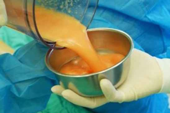 雙下巴抽脂手術費用詳解，價格因素與預算參考，雙下巴抽脂手術費用解析，預算參考與價格因素探討