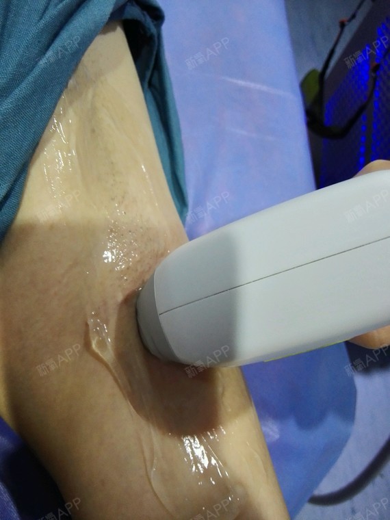 激光脫毛，疼痛感受與體驗解析，激光脫毛，疼痛感受與體驗詳解