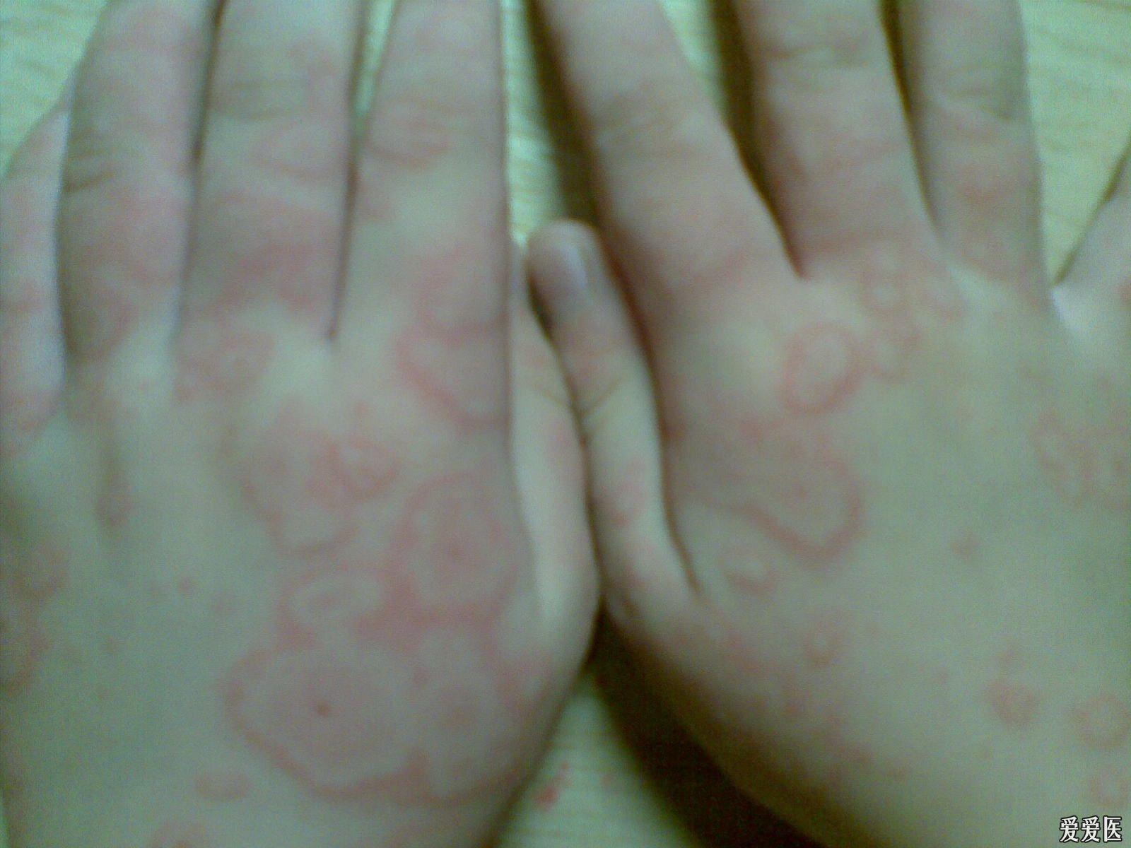 關(guān)于螨蟲過敏圖片與澳彩資料的查詢，來自94848.cσm的詳盡資源，螨蟲過敏圖片與澳彩資料查詢，詳盡資源來自94848.cσm