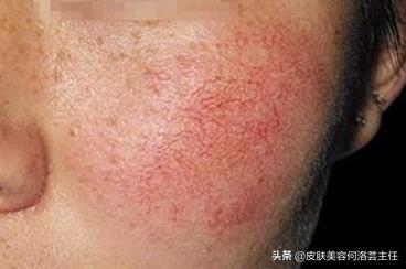 臉上有紅血絲怎么辦？全面解析治療方法，全面解析臉上紅血絲的治療方法