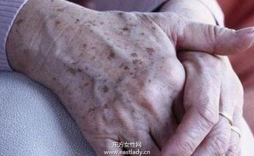 消除老年斑很簡單，方法與日常護理建議，日常護理小秘訣，輕松消除老年斑
