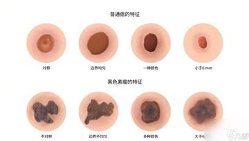 正常痣與黑色素瘤圖片，了解二者的區(qū)別與識別方法，正常痣與黑色素瘤圖片對比，區(qū)分與識別方法指南