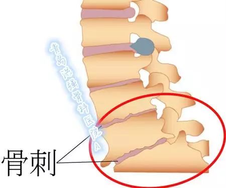 骨刺的最佳治療方法，骨刺的最佳治療方法解析