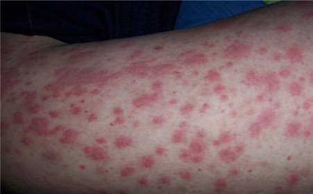 過敏性紫癜能自愈嗎？解析疾病真相與應(yīng)對之策，過敏性紫癜解析，能否自愈？真相與應(yīng)對策略探討