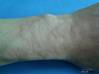 蕁麻疹患者的壽命，了解與應(yīng)對蕁麻疹的關(guān)鍵知識，蕁麻疹患者的壽命影響及應(yīng)對關(guān)鍵知識解析