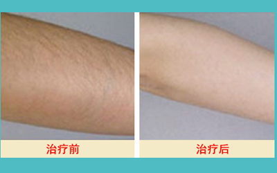 激光脫毛的價格解析，多少錢才能擁有絲滑肌膚？，激光脫毛價格詳解，多少錢能擁有絲滑肌膚？