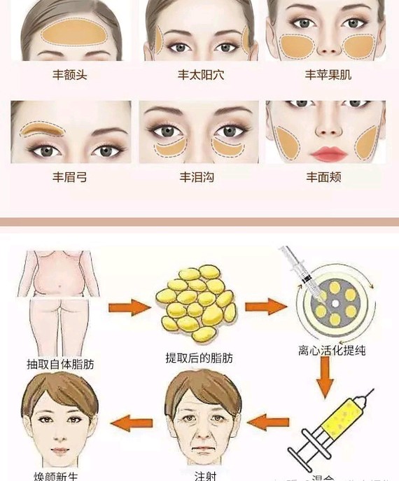 自體脂肪填充后最忌諱的幾個(gè)注意事項(xiàng)，自體脂肪填充后的關(guān)鍵注意事項(xiàng)與忌諱事項(xiàng)清單