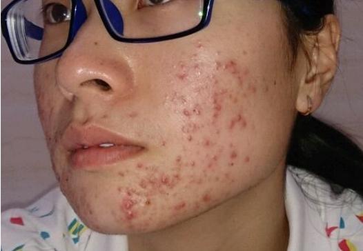 如何去除青春痘，男生的護膚指南，男生護膚指南，如何有效去除青春痘