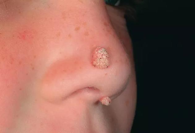 如何判斷是否為雞眼——全面解析雞眼癥狀與診斷方法，雞眼癥狀詳解，診斷方法與判斷指南