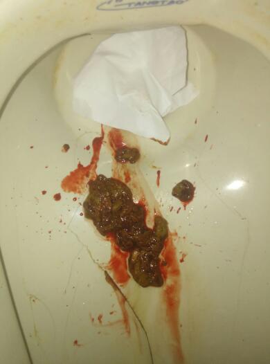 上大號拉出血怎么回事——解析便血的可能原因與應(yīng)對措施，解析，大便出血的原因及應(yīng)對措施