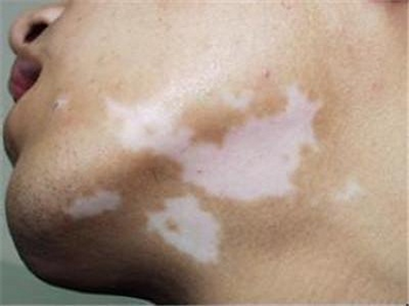 白點癲風(fēng)怎么治療效果最好，全面解析最佳治療方案，全面解析白點癲風(fēng)最佳治療方案，治療效果最大化