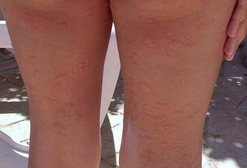 蕁麻疹的治療方法，全方位解析與應(yīng)對策略，全方位解析蕁麻疹治療方法與應(yīng)對策略