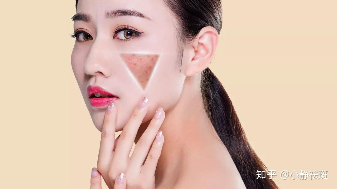 如何有效去除臉上的雀斑，最佳方法全解析，全面解析，如何有效去除臉上雀斑的方法