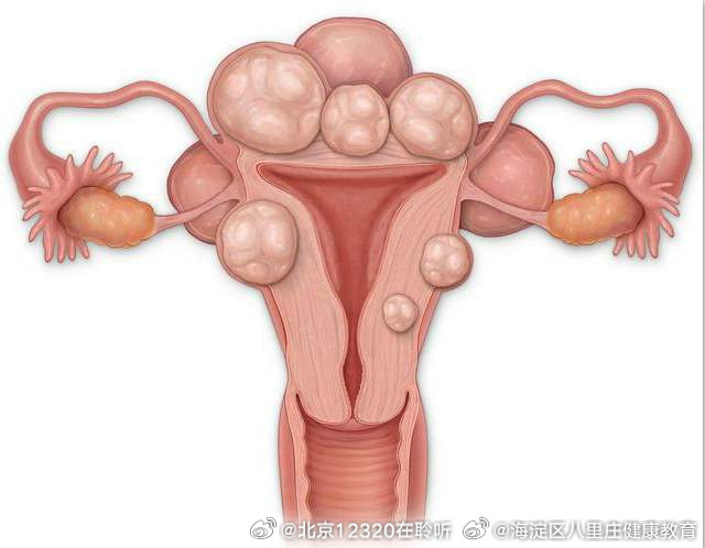 子宮肌瘤的最佳治療方法，全面解析與指導(dǎo)，子宮肌瘤的最佳治療方法詳解與指導(dǎo)手冊