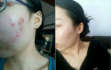 長(zhǎng)青春痘怎么處理最好？全面解析最佳應(yīng)對(duì)策略，全面解析青春痘最佳應(yīng)對(duì)策略，最佳處理方法與建議