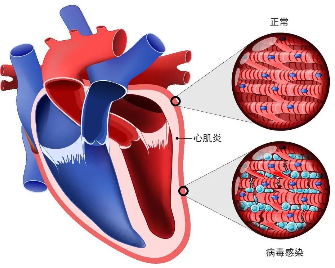 心肌炎，了解、預(yù)防與治療的重要性，心肌炎，了解、預(yù)防與治療的至關(guān)重要性